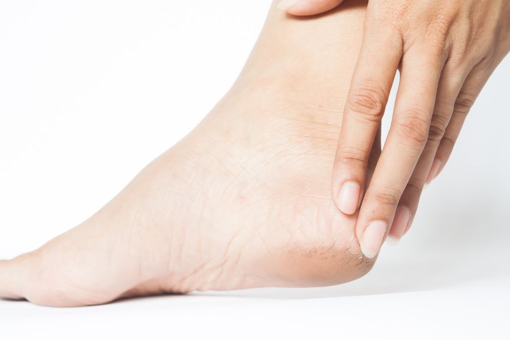 Sederet Cara Ampuh Mengatasi Kaki Pecah-pecah