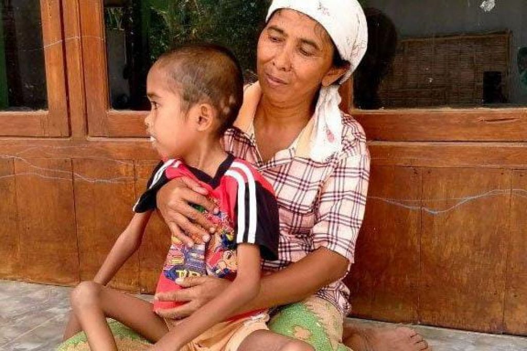 Bocah di Sampang Mengindap Penyakit APF, Korlap PPDI Serukan Pemerintah Turun Tangan