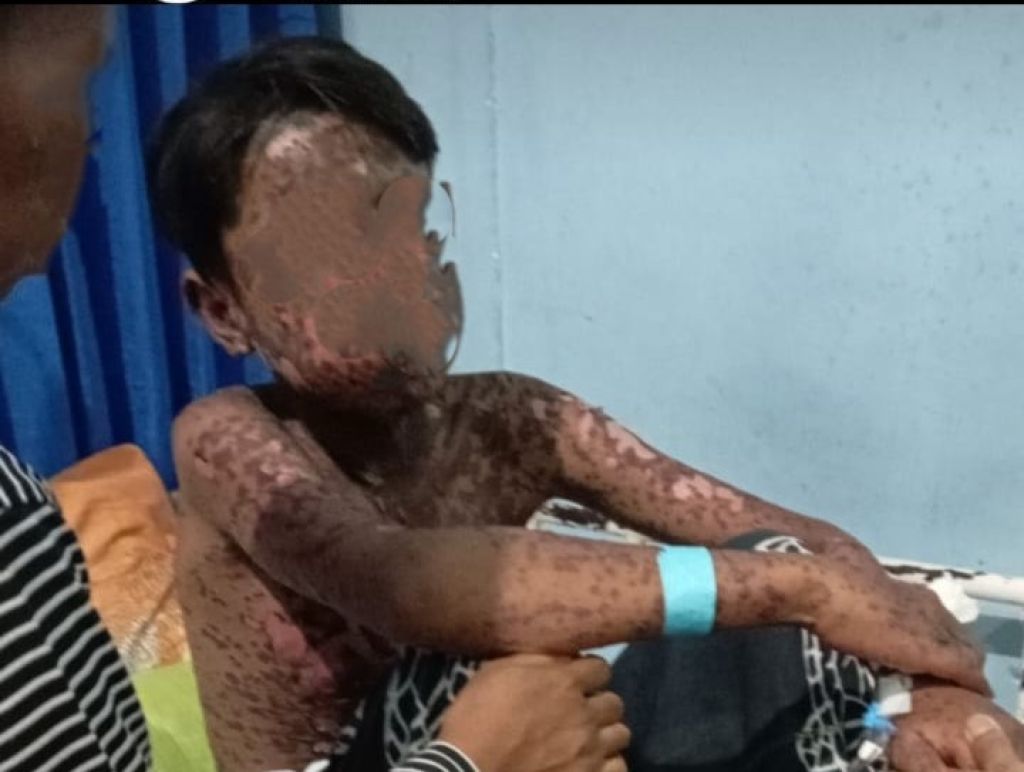 Bocah 14 Tahun di Jember Tubuhnya Melepuh Usai Mandi dalam Sungai