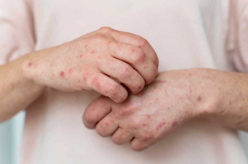 Mengenal Penyakit Lupus dan Gejalanya