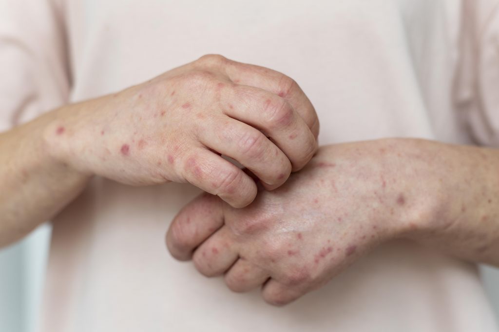 Akibat Sex Berisiko, Kasus Monkeypox di Indonesia Bertambah